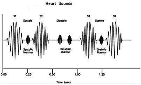 Figure 6 - Heart sounds